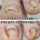 91 | 구의동 파고드는 내성발톱은 문제성 발관리 전문 풋풋한리쌤입니다.~