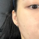 분당피부과 콜라겐스킨부스터 올리디아365 옆볼 앞볼 팔자 볼륨 효과 내돈내산 솔직후기