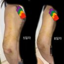 함미세탁 | 대전 팔뚝지방흡입 비용, 팔뚝 지방흡입 당일~12일차 까지의 모든것 (사진많음) 팔뚝 지흡 후 술, 팔...