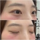 강남애교살 반영구 무보정 리얼 후기 1일~4일차 변화 공개 I 톡스앤필브로우 I