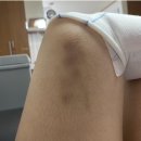 화상 응급처치, 심재성 2도 화상 후기 (대전 화병원)‼️ 징그러움 주의