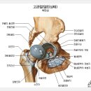 고관절 통증 참지마세요~!!//대퇴골두무혈성괴사//고관절인공관절// 이미지
