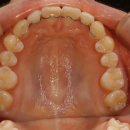 일산제일치과의원 | 일산 교정치과 추천 연세바로치과 턱통증까지 사라진 곳