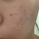 차한의원 | 부산 서면 새살침 한의원 패인흉터 치료 3회차 후기