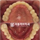 잇몸 염증으로 인한 치아 통증, 합정역 치과 전체 임플란트 로 신속하게 해결했습니다 - feat. 구강...