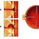 녹내장이란 ? 이미지