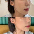 쿨시스템 - 남양주시 덕릉로 1103-1 | 구로피부과 추천 쿨소닉 리프팅 6000샷 심부볼 이중턱 쿨소닉통증 후기