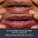 반제 | 포다이스반제거는 왜 아그네스 치료일까, 시술 후기와 효과 차이는 이렇습니다