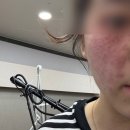 [공지] 수원역 피부과 동탄 루비레이저 주근깨 제거 가격 내돈내산 (1,2일차 후기)