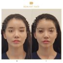 청담 보나트페이스 비대칭 교정 윤곽교정 후기