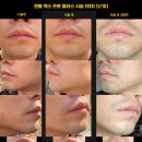 GS25 운정젠틀점 | 파주 운정 턱수염 레이저 제모 2회차 후기 | 스노우의원 젠틀맥스프로플러스