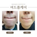 입주위 여드름 원인 및 해결 방법