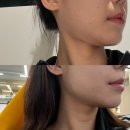 신사역 피부과 이중턱 지방분해주사 사각턱 보톡스 일주일 효과 붓기 가격 후기