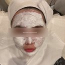 압구정-223 | 압구정 로데오 피부과 | 여드름 치료 목적으로 포텐자 아그네스 레이저 받은 후기 (고통 정도, 경과)
