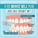 전치과기공소 | [수원 우만동 치과] 아주대삼거리 치과 벌어진 앞니 치료