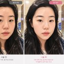 샘광고레이져 | 내돈내산 | 광고no | 리바이브 vs 올리지오(2회) 리프팅 비교 후기 (통증 • 가격 • 효과)