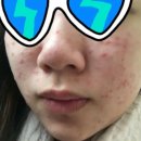 인약국 | 붉은 여드름 자국 연고 약국 가격 효과 후기