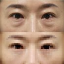 옳은손성형외과 중년눈성형 만족해요