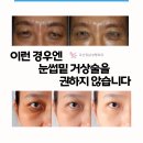 혜민의원 | 이런 경우엔 눈썹밑 거상술을 권하지 않습니다