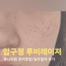 박차돈 | 압구정 루나의원 루비레이저 부작용 관리방법 및 내돈내산 일주일차 후기