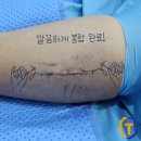 팔 지방종 몽우리 정형외과에서 제거 수술 과정 소개