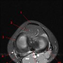 MRI of the knee: T2-weighted FATSAT, Axial Sections/ axial view(위-＞아래로) 이미지