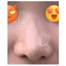 주내로 | [내돈내산] 10년된 코 보형물 전체제거_상담편