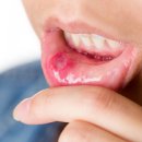 입 안에 생긴 염증… 어떻게 빨리 없앨까? 이미지