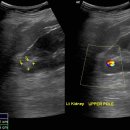 Left renal cyst with suspicous wall calcifcation or milk of calcium 이미지