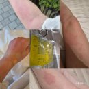 미주약국 | 급성 두드러기 원인과 증상, 피부과 내과 모두 가본 일주일 후기