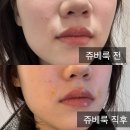 청담동 쥬베룩 볼륨 팔자 콜라겐 부스터 필러 통증 효과 가격 부작용 주차별 후기