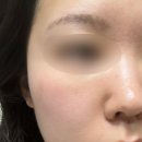 아카이브청담의원 | 아카이브 청담의원 리쥬베룩(리쥬란+쥬베룩)모공 솔직 후기 / 멍, 통증, 효과