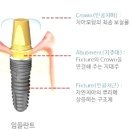 임플란트 과정과 치료기간? 이미지