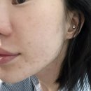 케이아이(주) | 내돈내산 케이아이 엑소좀 앰플 + MTS 조합 광명찾은 여드름러 사용기 (초 강추)