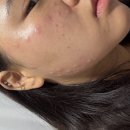 강남비비의원 | 강남역 서울비비의원 브이라인 보톡스 일주일 차 내돈내산 솔직 후기