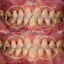 선메디칼(Sun medical) | 찬물 마실때 찌릿한 명륜동시린이, 치과에서 떼운 레진이 자꾸 떨어지는 숨은이유