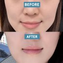 하이퍼 - 포항시 북구 초곡지구로71번길 23 | 명동 피부과 하이퍼 티타늄 리프팅 내돈내산 후기