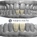 의왕시 치과 벌어진 앞니 사이 라미네이트 보철로 이뻐지기