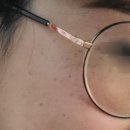 포메디한의원 | [포메디한의원] 인천 구월동 기미 주근깨 잡티 제거 토닝레이저 내돈내산 5회차 마무리 후기