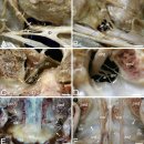 디스크 파열 통증.. 요추 2-3번, 요추 4-5번 추간판 .. 동척추신경(체성, 자율신경)지배? 이미지