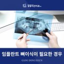 암사역치과, 임플란트 뼈이식 꼭 필요한 경우와 다른 방법은 이미지