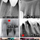 강동구 포레온 건너편 참좋은김치과 / 엔도위즈 데모 1주일만에 구매하겠다는 엔도에 진심인 원장님