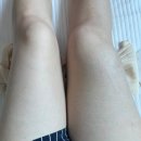 큰꽃지천 | 정맥성 혈관기형 치료후기 - 경화요법 시술(1)