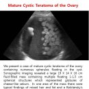 Mature Cystic Teratoma of the Ovary 이미지