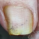 홀드핀칭 이미지