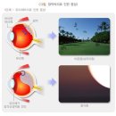 선택적 망막 치료술[Selective Retina Therapy] 이미지