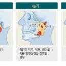 치명적인 침샘암 (턱밑 멍울, 귀밑 몽우리, 안면신경마비) 이미지