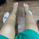 20대 하지정맥류 수술 후기(포항 수 흉부외과 - 클라리베인)