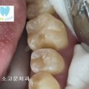 고운 치과기공소 이미지