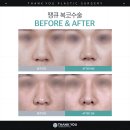 땡큐 | 복코수술후기 찾는다면, 땡큐 어때?